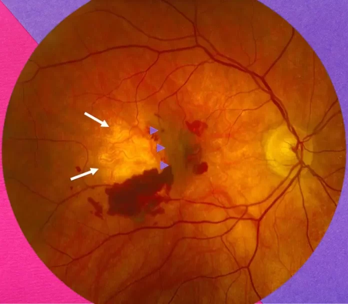 What is the Retinal Pigment Epithelium and Why is it Important?